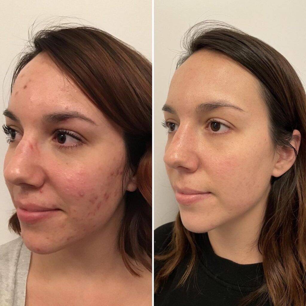 Strahlende Haut in nur einer Sitzung 14 Aquafacial Carbon Peel Before After 2
