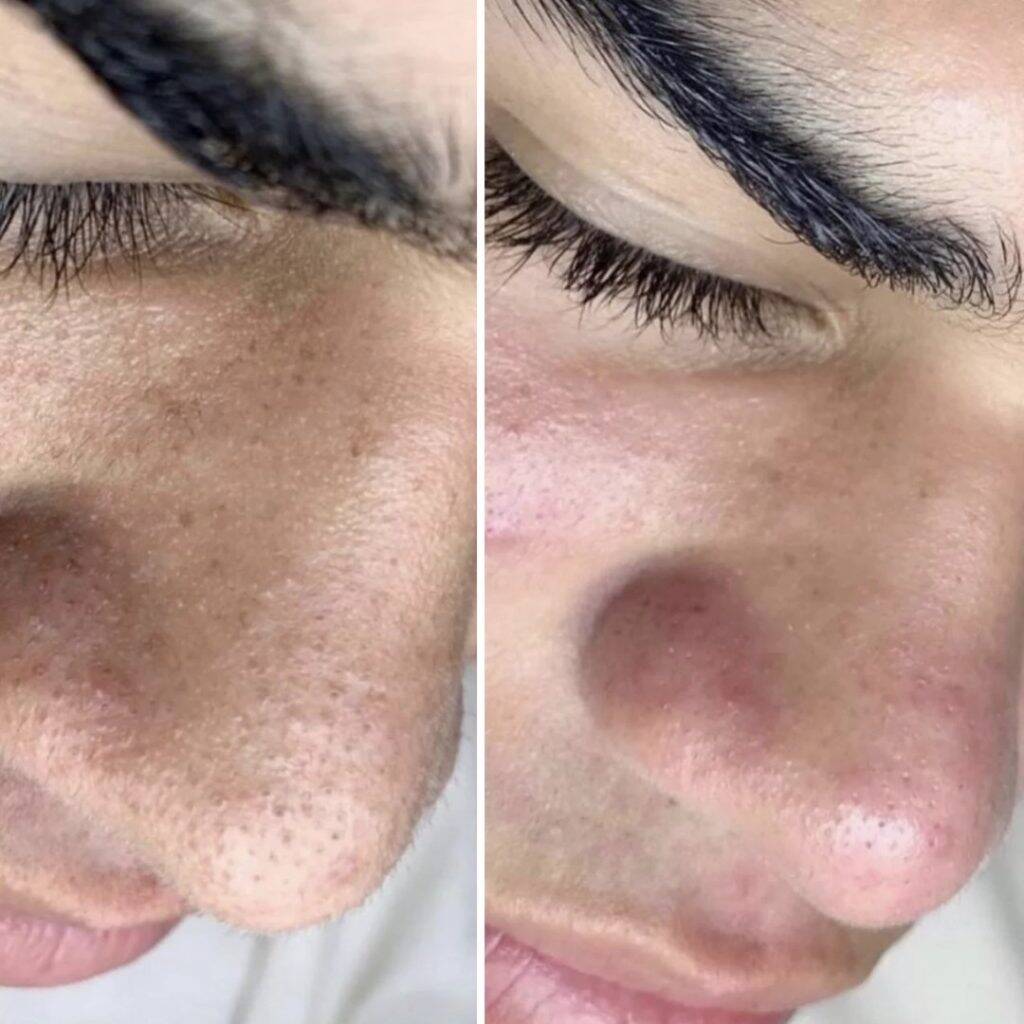 Aquafacial Carbon Peel Before After 3