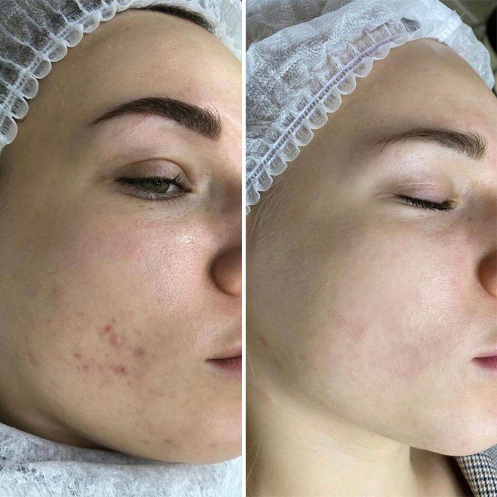 Strahlende Haut in nur einer Sitzung 12 Aquafacial Carbon Peel Before After 4