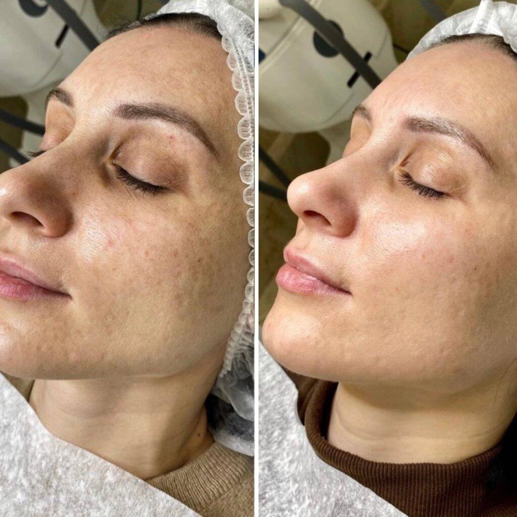 Strahlende Haut in nur einer Sitzung 11 Aquafacial Carbon Peel Before After 6