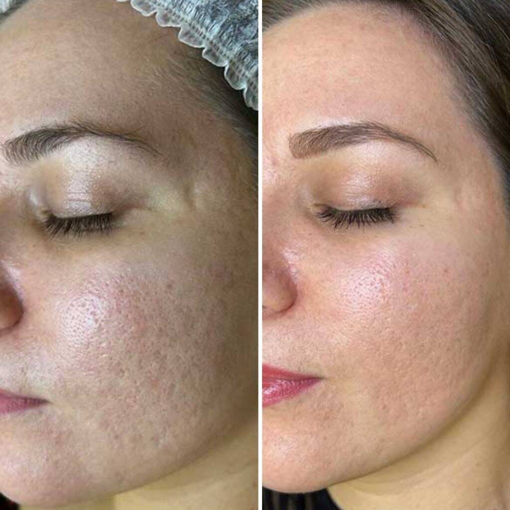 Strahlende Haut in nur einer Sitzung 4 Aquafacial Carbon Peel Before After 7