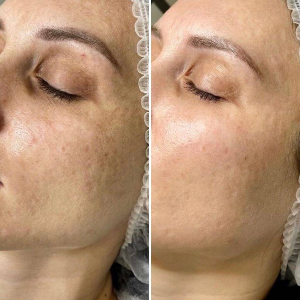carbon laser peeling