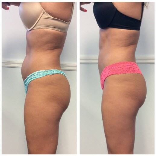 side-coolsculpting-trusculpting-before-after