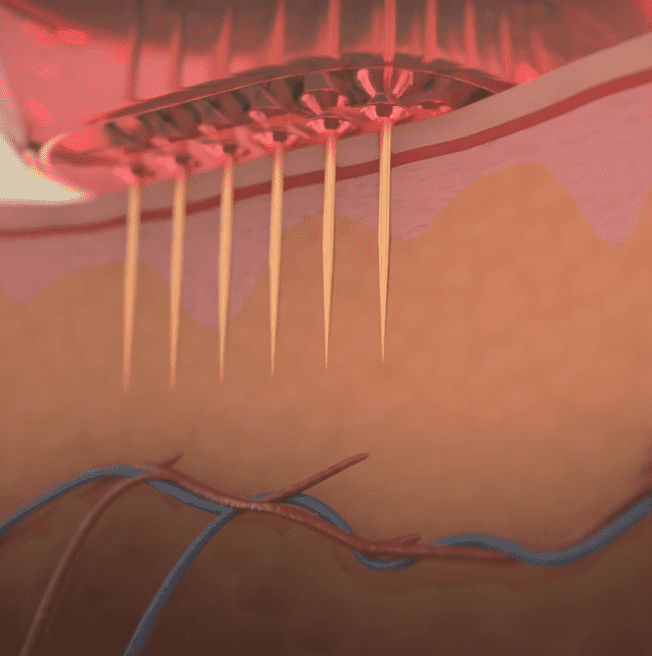 Radiofrequenz Microneedling