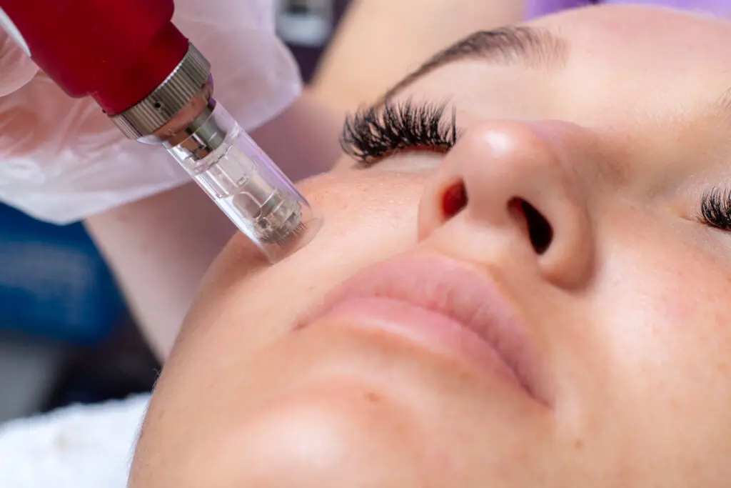 microneedling wien