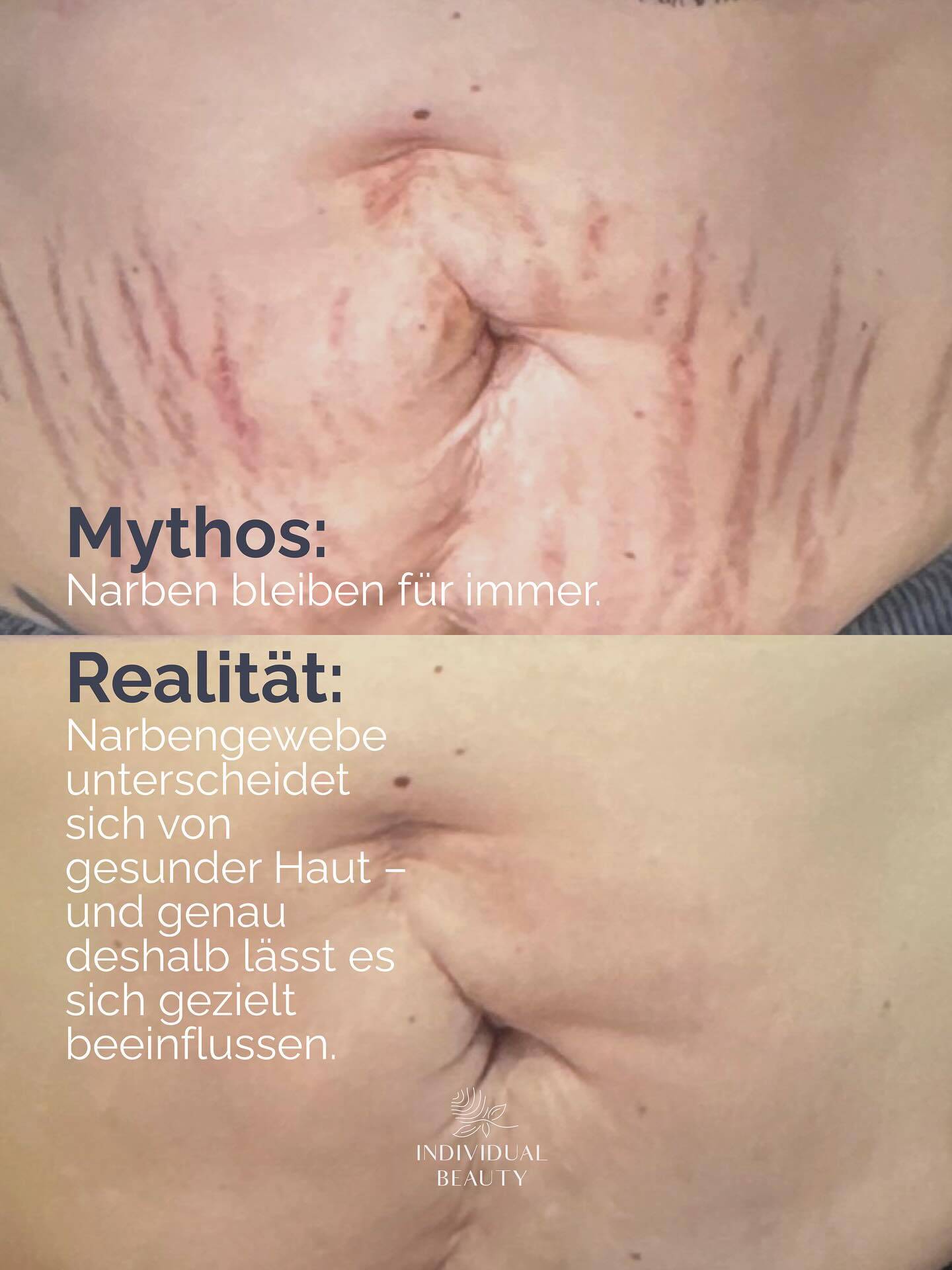 Narben erzählen eine Geschichte – aber sie müssen nicht für immer sichtbar bleiben.
Mit Methoden wie dem Plasma Pen unterstützen wir die Haut dabei, sich selbst zu erneuern.
Und genau das macht den Unterschied, ob es unverändert bleibt oder sich sichtbar verbessert.
#wienbeauty #viennabeauty #plasmapen #narben #aknenarben #narbenbehandlung #narbenpflege #aknebehandlung #hautpflege #skincare #hautgesundheit #beautytreatment #beautycommunity #skincarecommunity #wien #vienna #austria #wienliebe