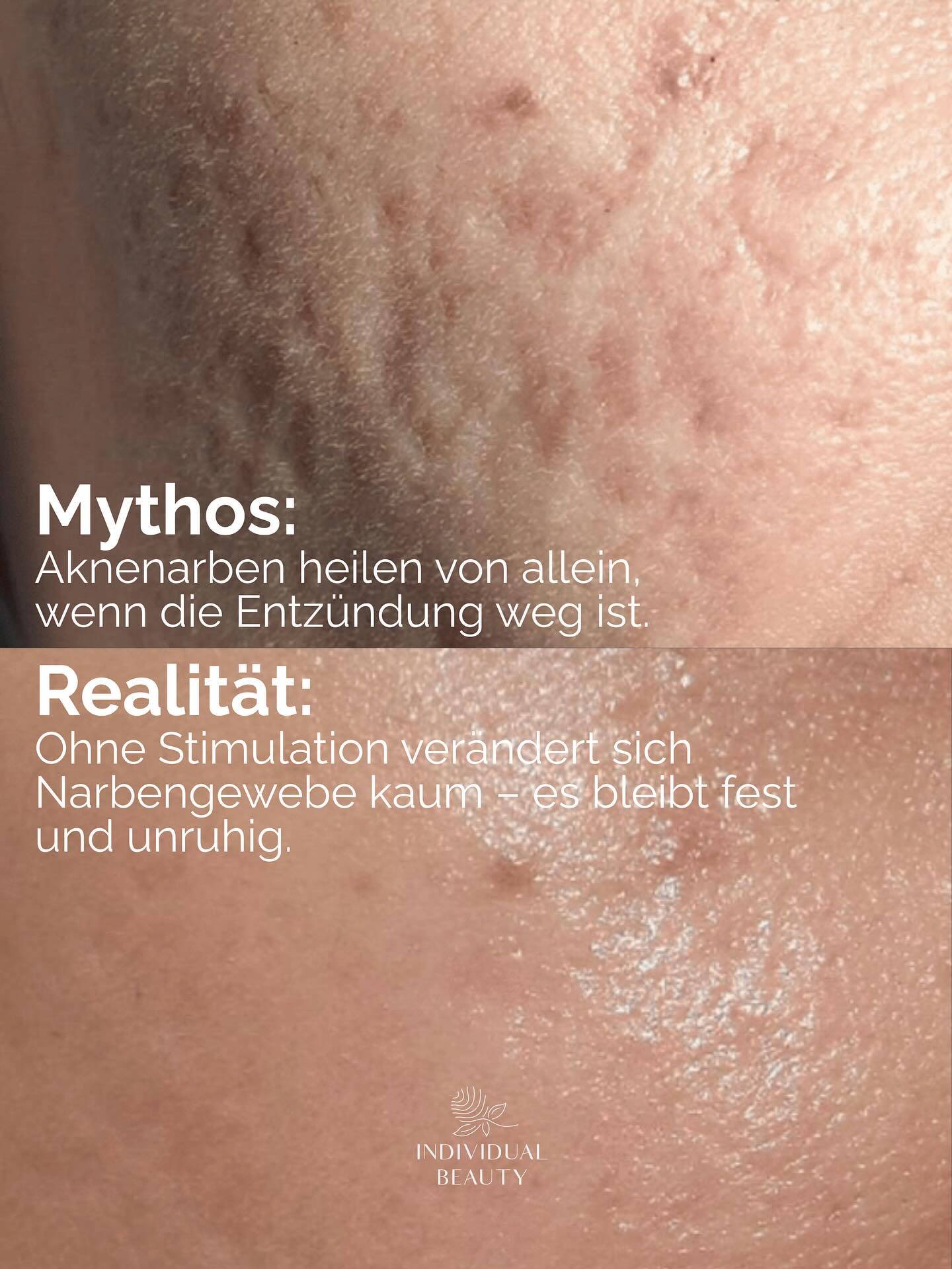 Narben erzählen eine Geschichte – aber sie müssen nicht für immer sichtbar bleiben.
Mit Methoden wie dem Plasma Pen unterstützen wir die Haut dabei, sich selbst zu erneuern.
Und genau das macht den Unterschied, ob es unverändert bleibt oder sich sichtbar verbessert.
#wienbeauty #viennabeauty #plasmapen #narben #aknenarben #narbenbehandlung #narbenpflege #aknebehandlung #hautpflege #skincare #hautgesundheit #beautytreatment #beautycommunity #skincarecommunity #wien #vienna #austria #wienliebe