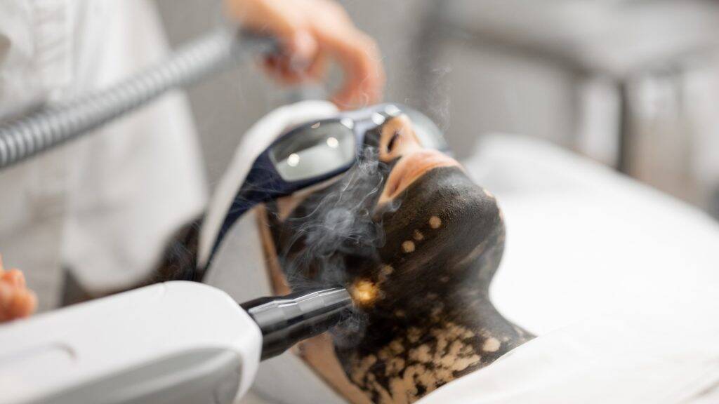 carbon peeling