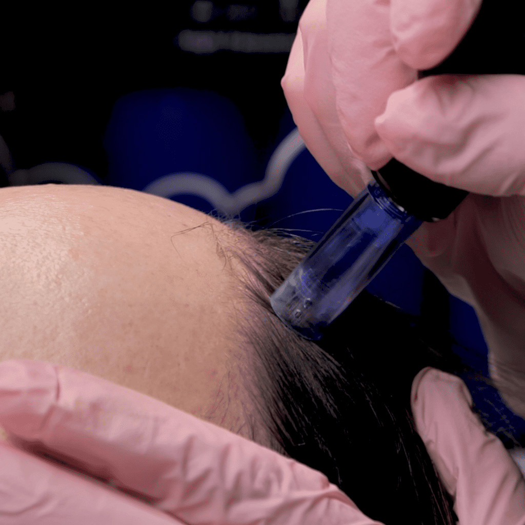 Haarausfall Wien 2 microneedling
