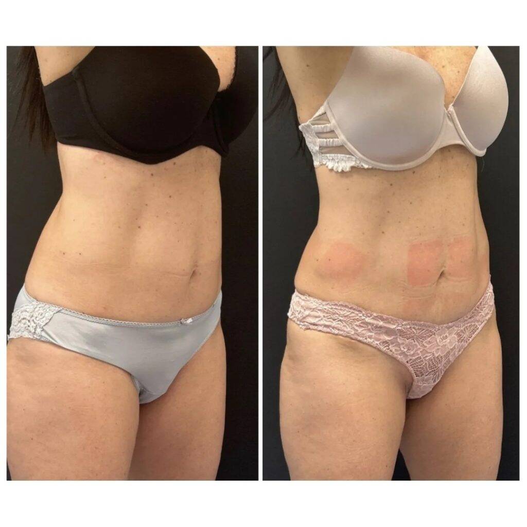 MD Sculpt Bodyforming bei Individual Beauty Wien 7 md sculpt before after