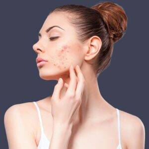 1-acne-before-mobile