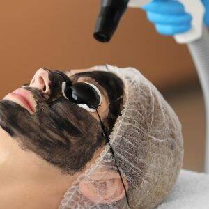 carbon peeling kosten