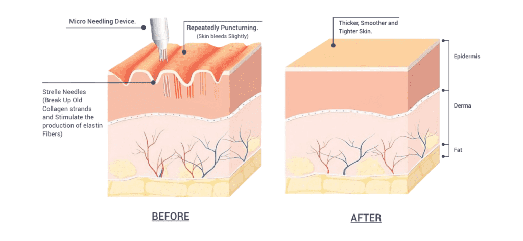 Microneedling 7 microneedling gallery 2