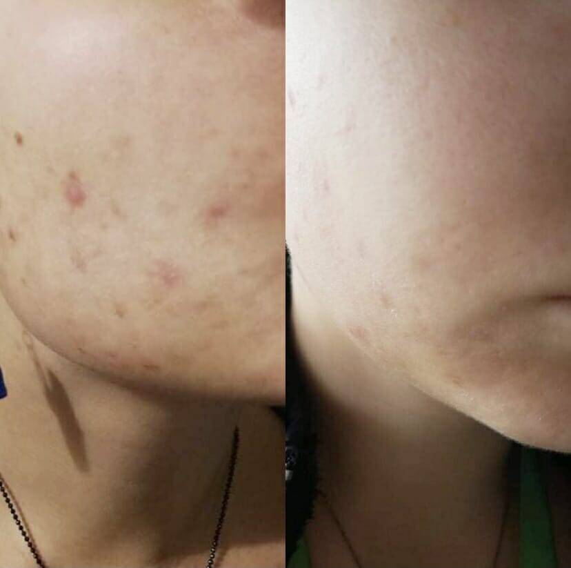 Die besten Microneedling vorher nachher Ergebnisse: Vor- und Nachteile im Überblick 2 Fruchtsäurepeeling+Microneedling - Fruchtsäurepeeling