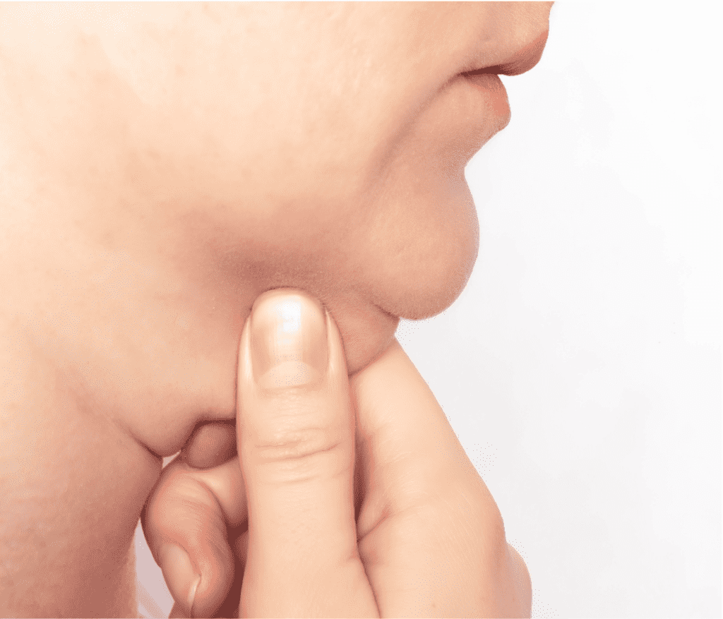 Doppelkinn entfernen 1 Doppelkinn kryolipolyse