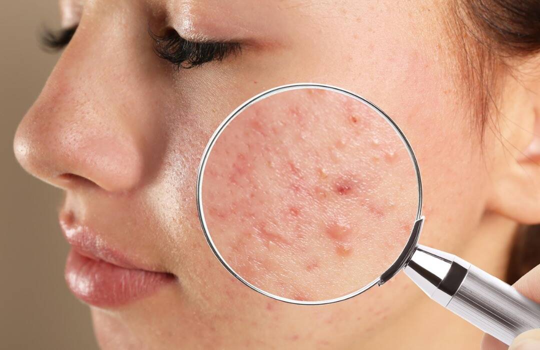 IPL Laser Wien – Laser-Gesichtsbehandlungen 4 IPL Akne 1