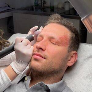 Haarausfall Wien 8 Plasma Pen Daneil 2
